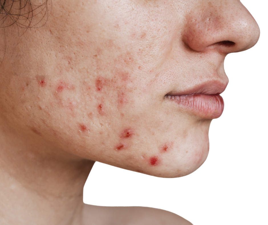 acne