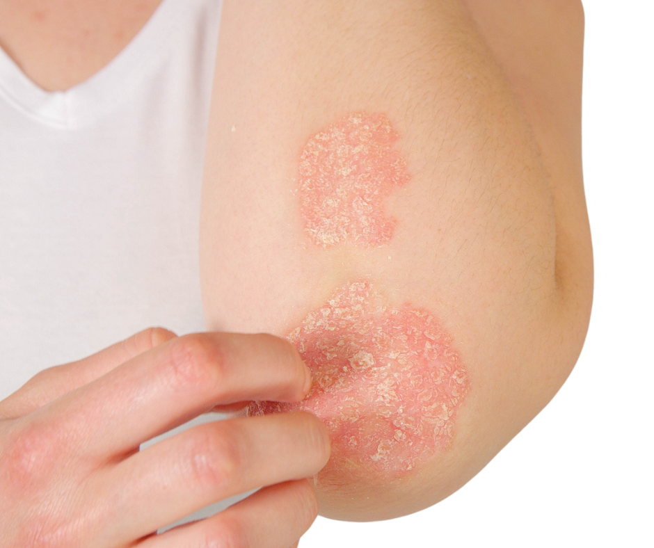 eczema