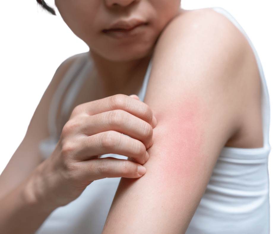 rashes